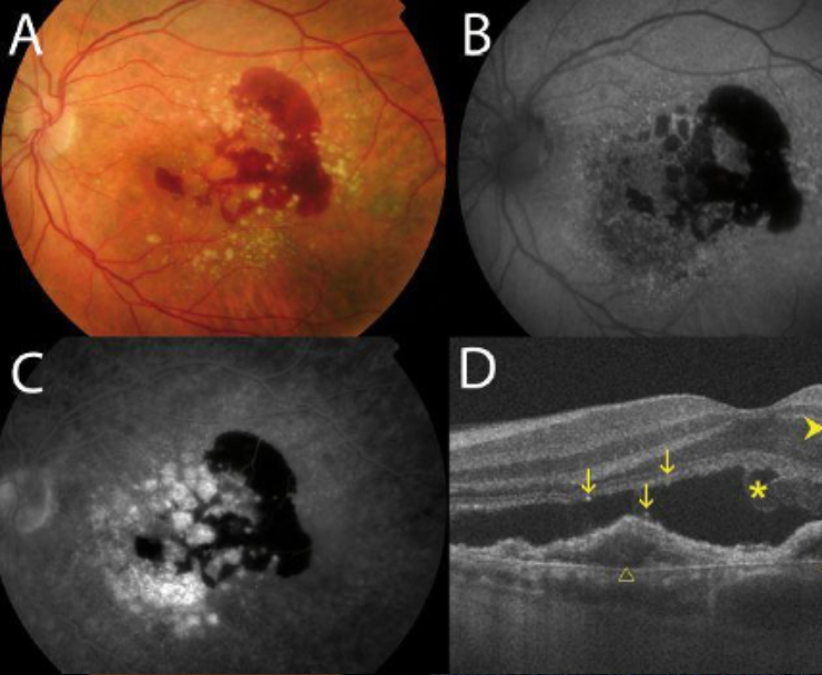 Age-Related Macular Degeneration (AMD) Wet (i.e. Exudative Macular Degeneration)