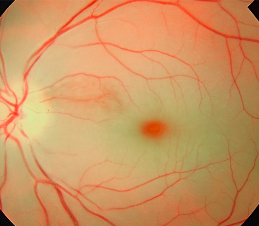 Artery Occlusion