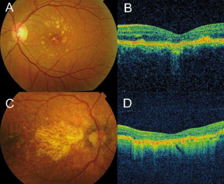 OCT of Atrophic Macular Degeneration