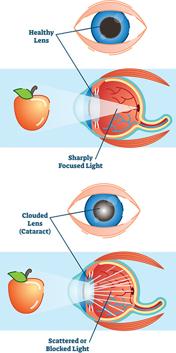Cataracts diagram