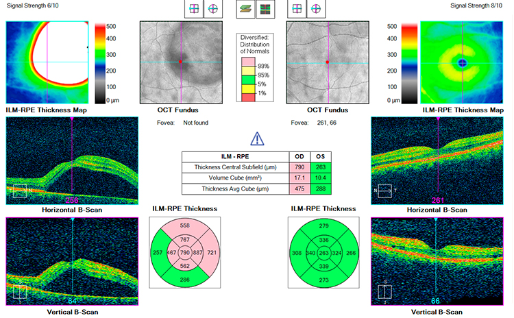 Central Serous Retinopathy