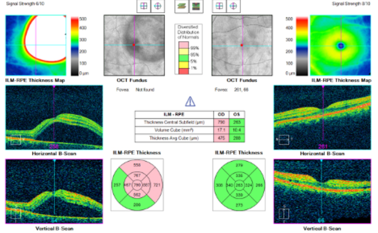 Central Serous Retinopathy OCT chart