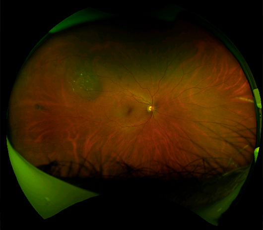 Congenital Hypertrophy of the Retinal Pigment Epithelium (CHRPE)