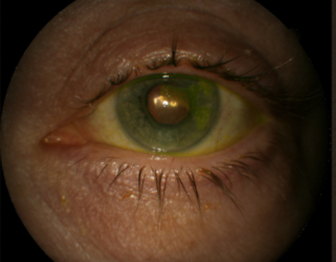 Corneal Abrasion