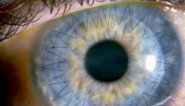 Corneal Transplant