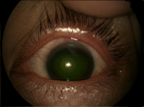 Corneal Ulcer