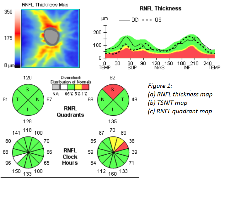 RNFL Thickness Map