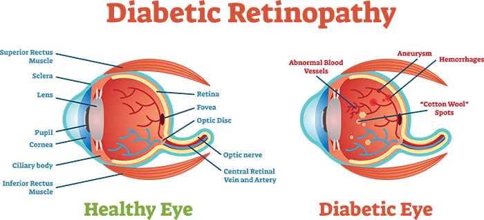 Diabetic Retinopathy graphic showing difference between an healthy eye and a diabetic eye.