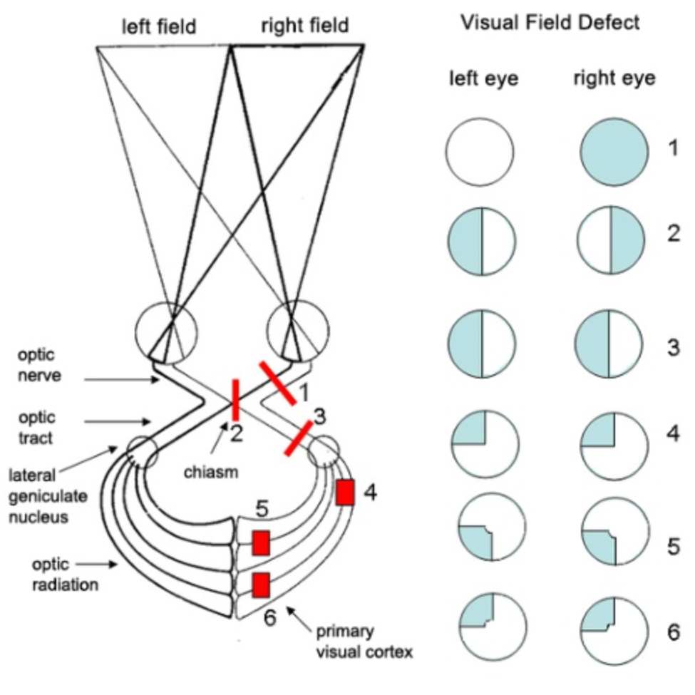 Diagram of Visual Field Defect