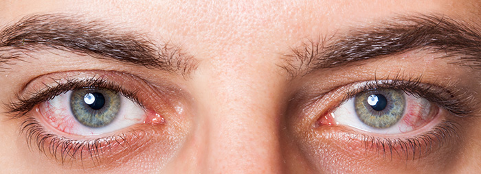 Close up of red, dry eyes