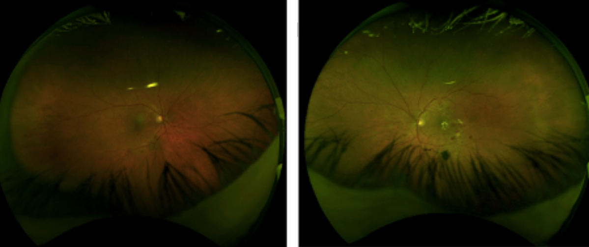 Close up of eye with diabetic retinopathy