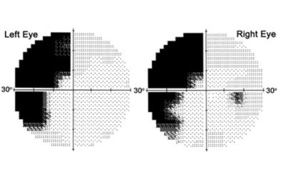 Eye charts after a stroke