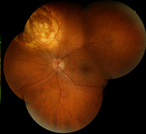 Tumor of the Eye - Melanoma