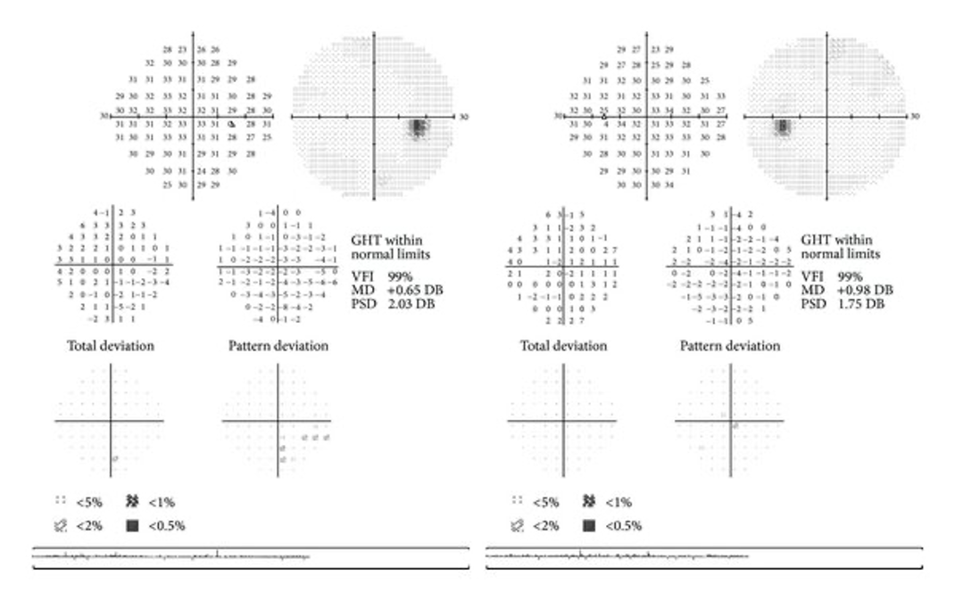 Full Visual Field chart