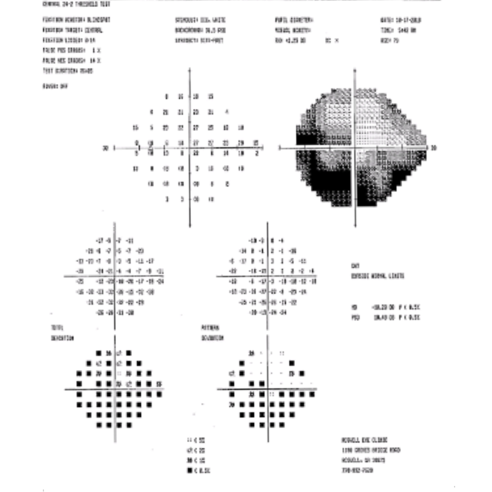 Glaucoma chart