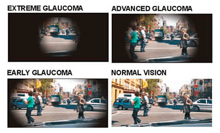 Stages of Glaucoma