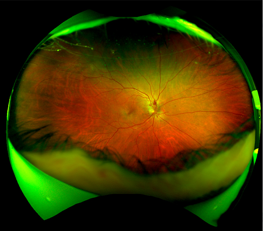 Hypertensive retinopathy