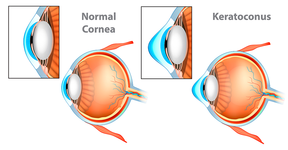 Illustration of normal cornea versus keratoconus.