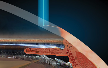 Laser incisions illustration