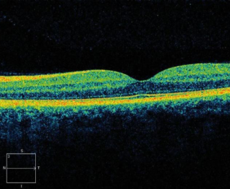 OCT - normal macula