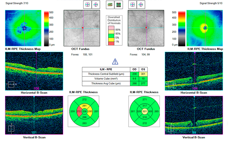 Macular hole