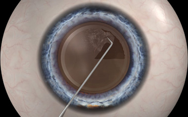 Manual capsulorhexis