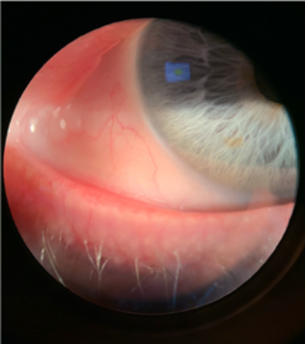 Meibomian Gland Dysfunction 