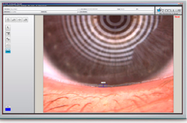 Meniscus Tear Height