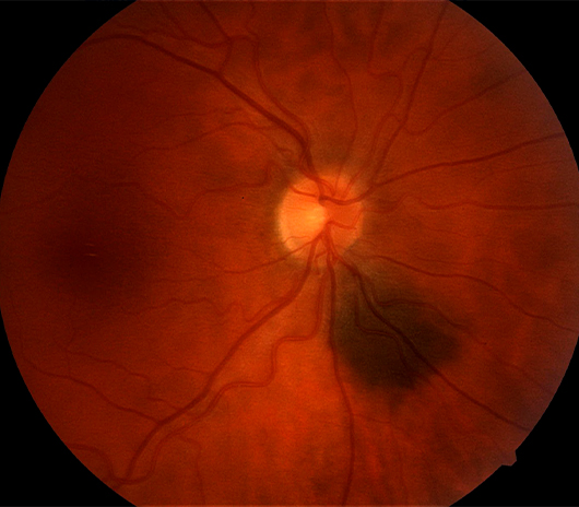 Choroidal Nevus