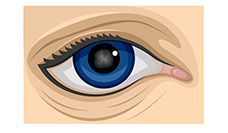 Illustration of three types of cataracts, such as cortical, nuclear and posterior capsular cataracts