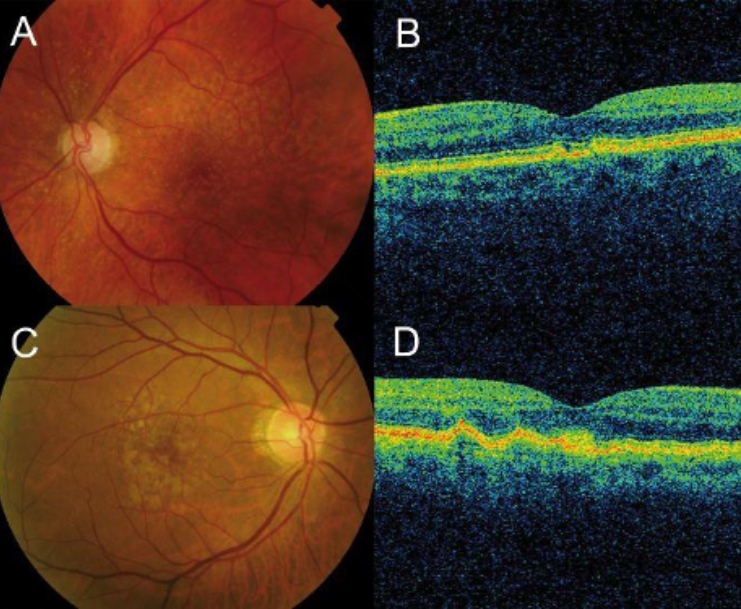 OCT of Age-Related Macular Degeneration (AMD) Dry