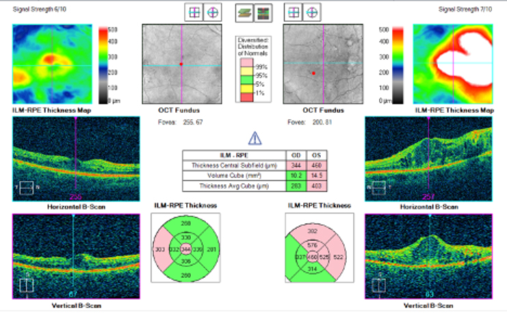 OCT of Diabetic Retinopathy/Macular-Edema