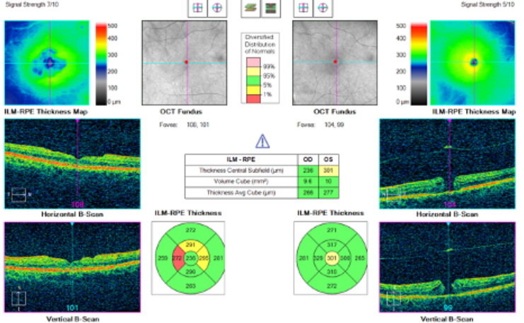 OCT charts of macular hole