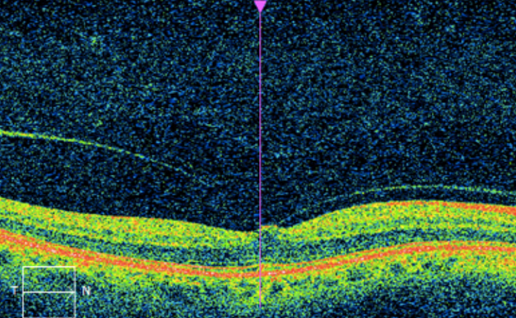 OCT of vitreous traction