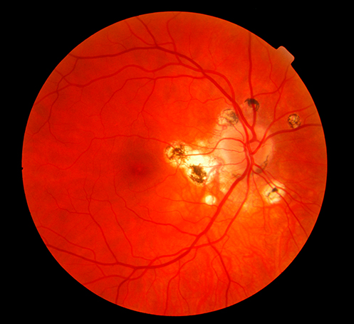 Ocular Histoplasmosis