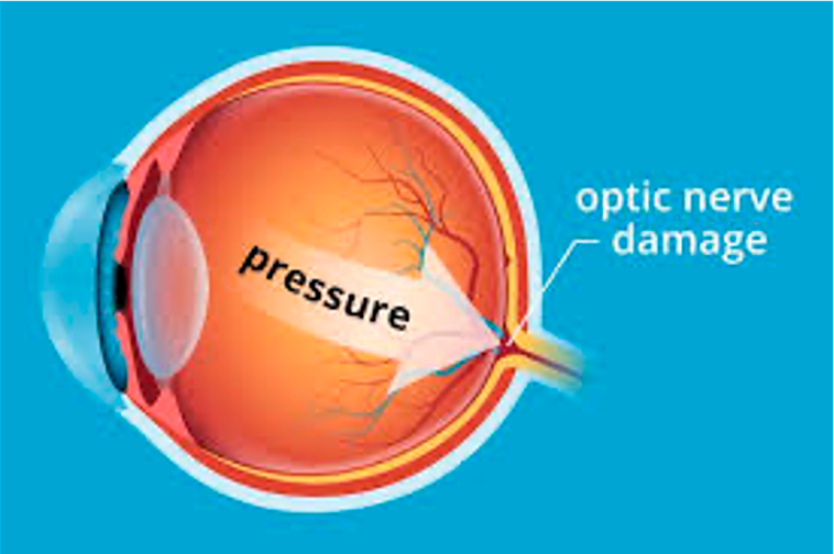 Illustration of optic nerve damage