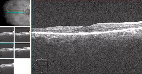 Plaquenil Toxicity