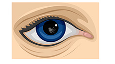 Illustration of three types of cataracts, such as cortical, nuclear and posterior capsular cataracts