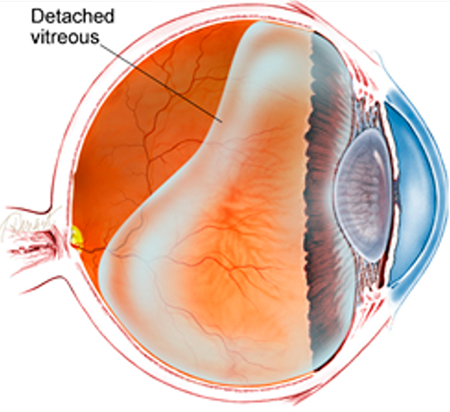 Posterior Vitreous Detachment