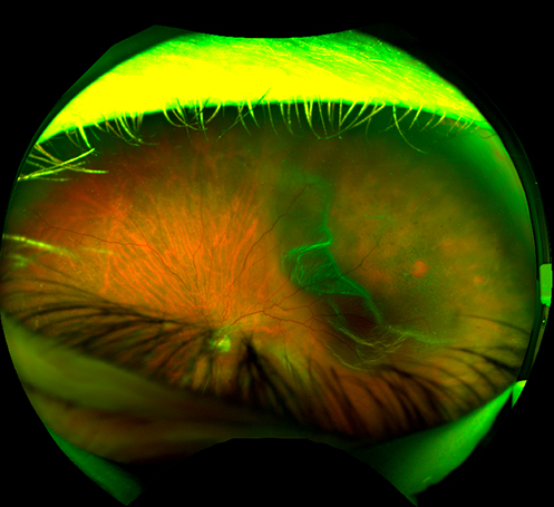 Retinal Detachment