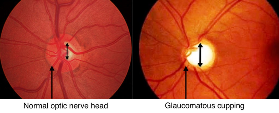 Retinal photography