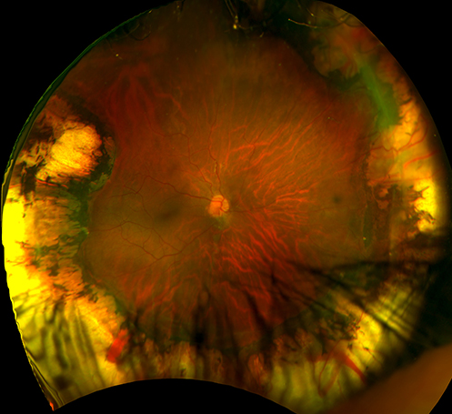 Retinal Prematurity