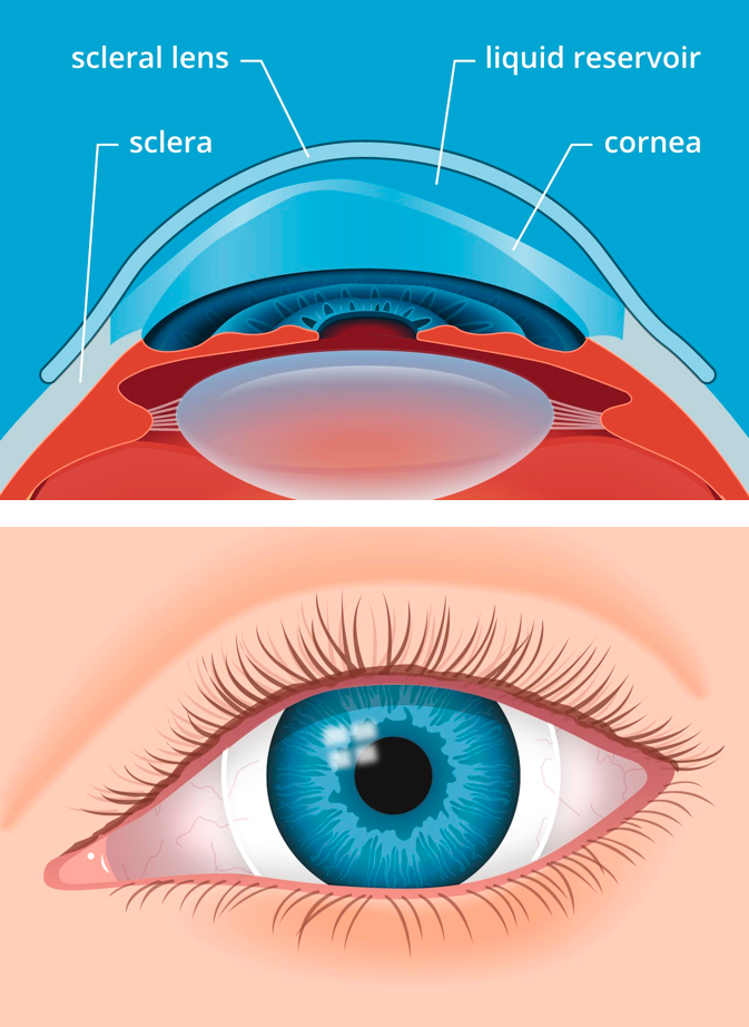 Scleral lens illustration of the eye