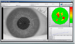 Non-Invasive Tear Break-Up Time (NITBUT)