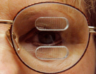 Close up of a man's eye with glasses on and a type of visual field expanders on the glasses