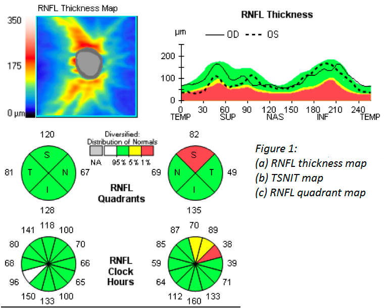 RNFL Thickness Map