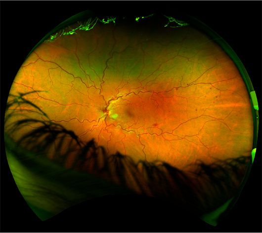 Vein occlusion